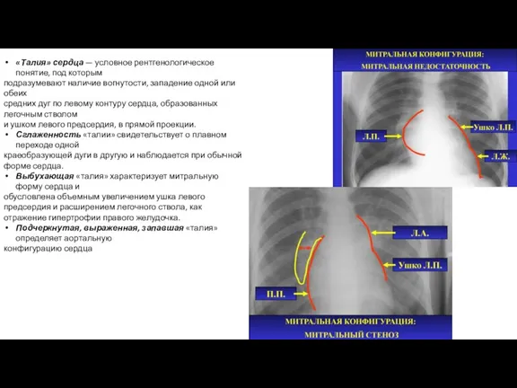 «Талия» сердца — условное рентгенологическое понятие, под которым подразумевают наличие вогнутости, западение одной