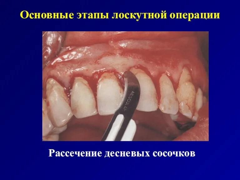 Основные этапы лоскутной операции Рассечение десневых сосочков