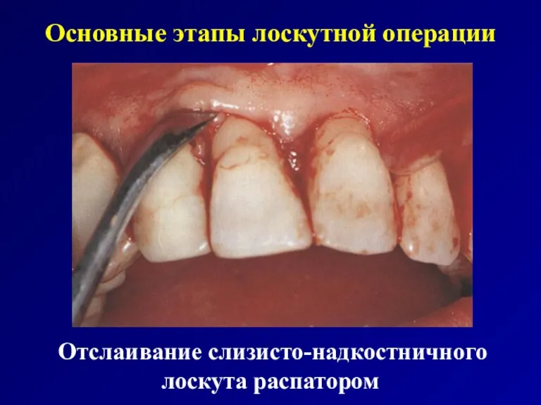 Основные этапы лоскутной операции Отслаивание слизисто-надкостничного лоскута распатором