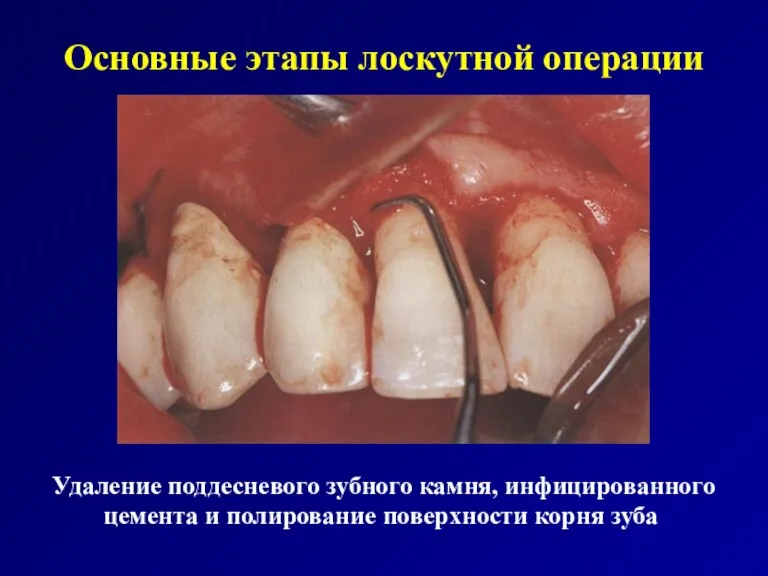 Основные этапы лоскутной операции Удаление поддесневого зубного камня, инфицированного цемента и полирование поверхности корня зуба