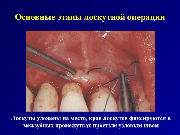 Основные этапы лоскутной операции Лоскуты уложены на место, края лоскутов