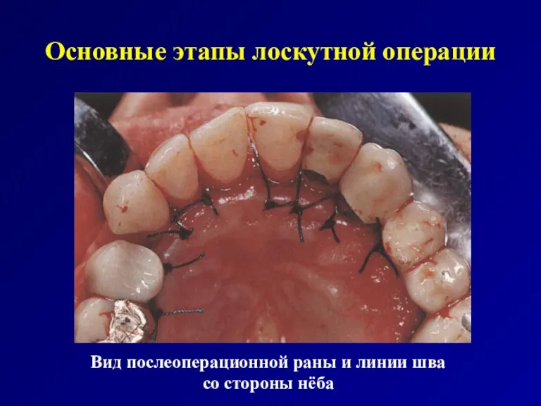 Основные этапы лоскутной операции Вид послеоперационной раны и линии шва со стороны нёба