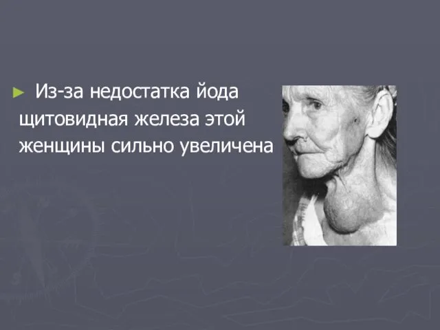 Из-за недостатка йода щитовидная железа этой женщины сильно увеличена