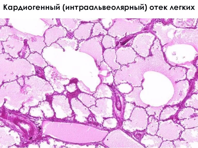 Кардиогенный (интраальвеолярный) отек легких