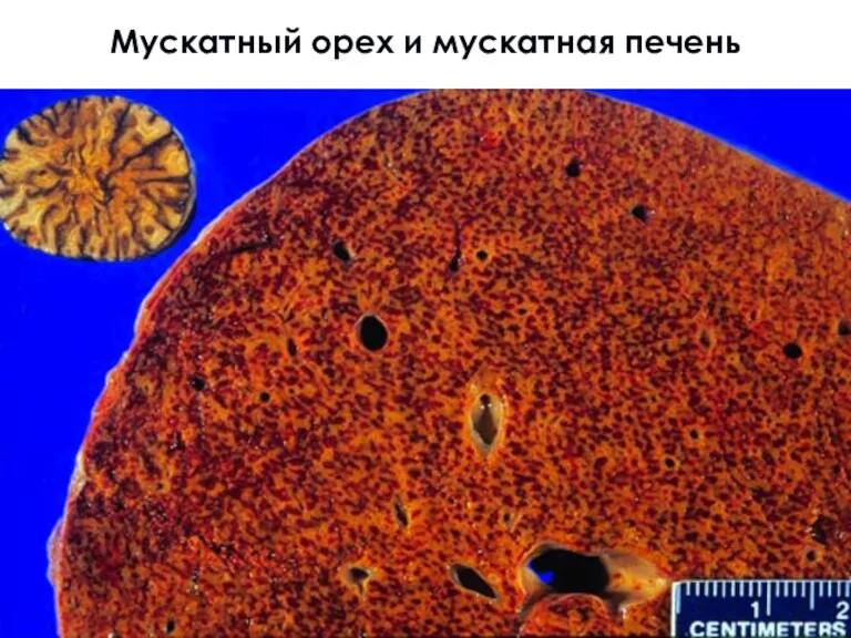 Мускатный орех и мускатная печень