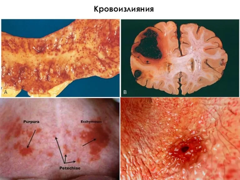 Кровоизлияния