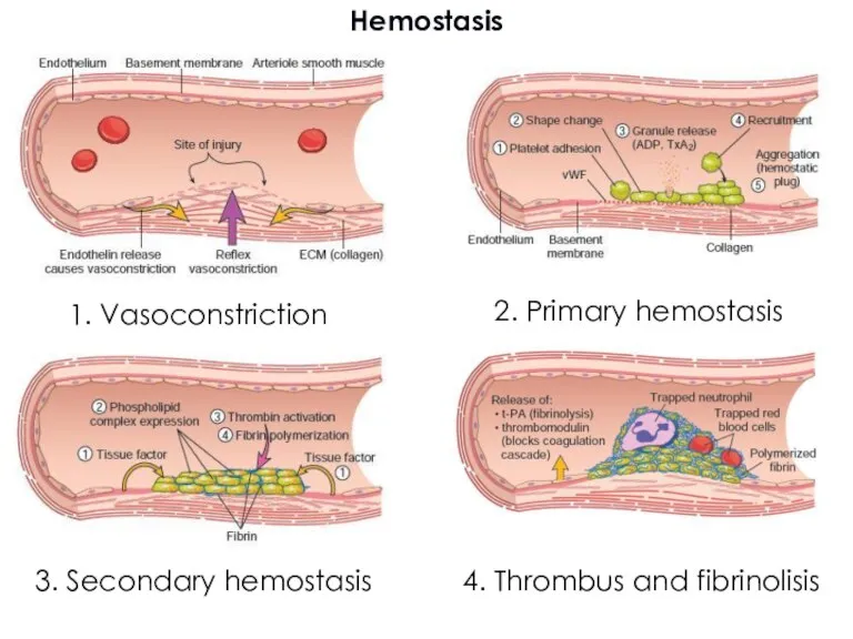 Hemostasis 1. Vasoconstriction 2. Primary hemostasis 4. Thrombus and fibrinolisis 3. Secondary hemostasis