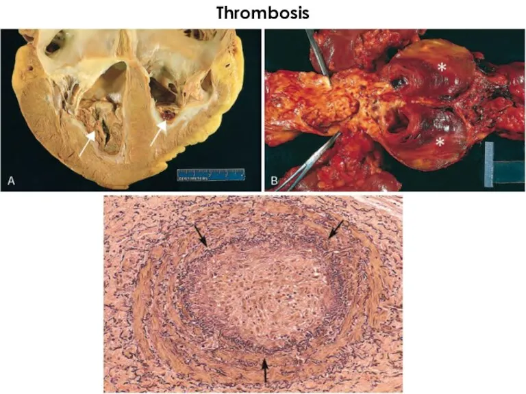 Thrombosis