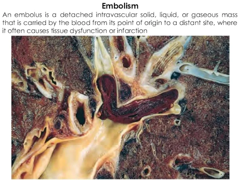 Embolism An embolus is a detached intravascular solid, liquid, or