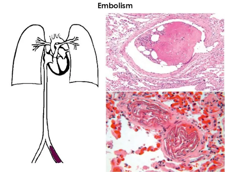 Embolism