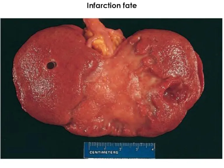 Infarction fate