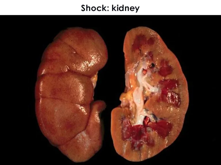 Shock: kidney