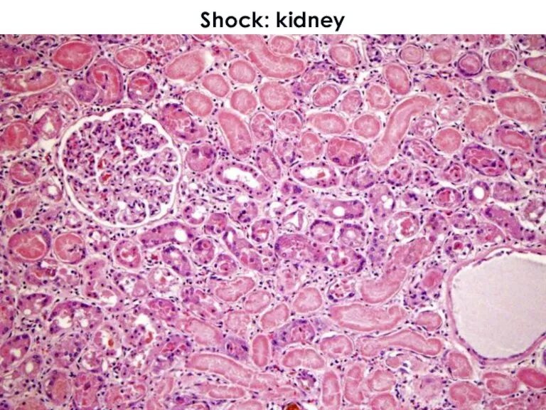Shock: kidney