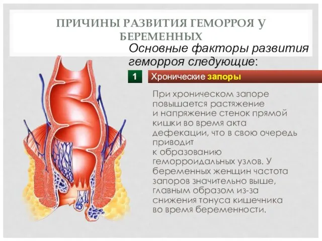 ПРИЧИНЫ РАЗВИТИЯ ГЕМОРРОЯ У БЕРЕМЕННЫХ При хроническом запоре повышается растяжение