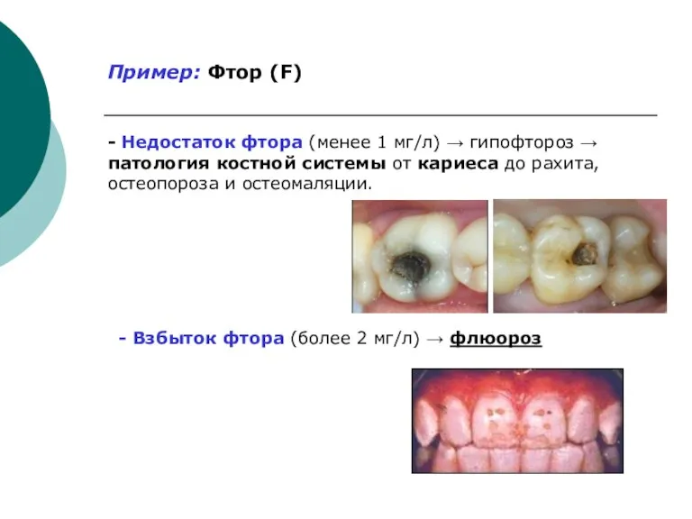 Пример: Фтор (F) - Недостаток фтора (менее 1 мг/л) → гипофтороз → патология