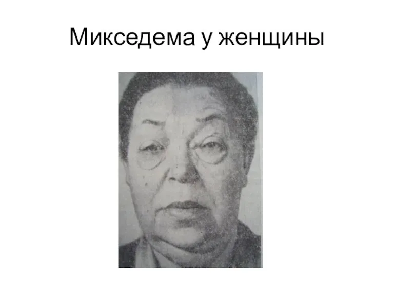 Микседема у женщины