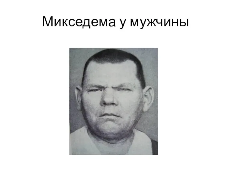 Микседема у мужчины