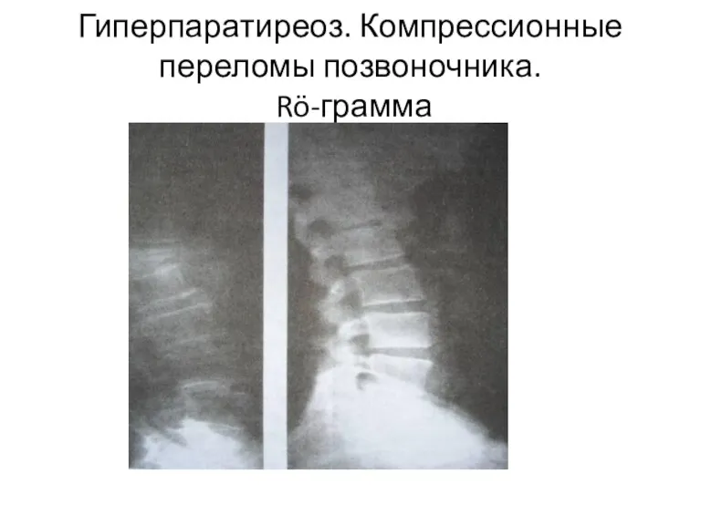 Гиперпаратиреоз. Компрессионные переломы позвоночника. Rö-грамма