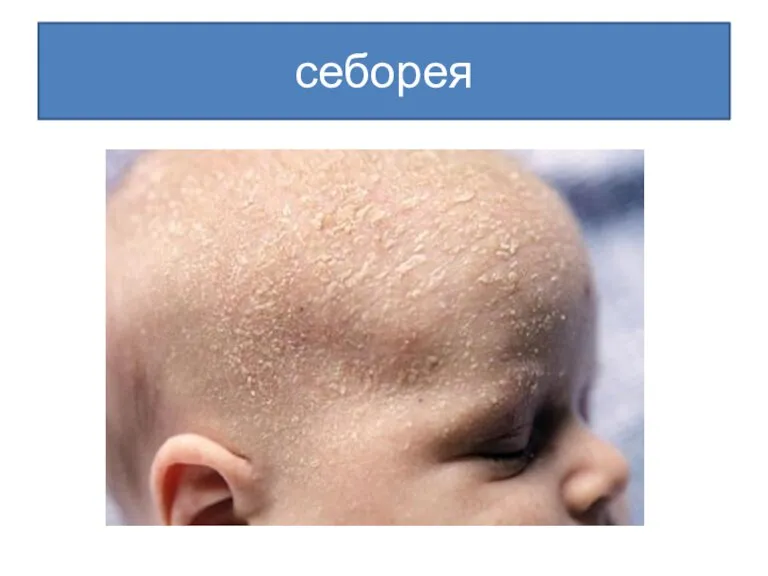 себорея