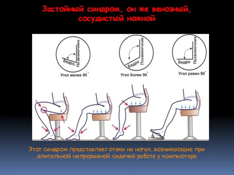 Этот синдром представляет отеки на ногах, возникающие при длительной непрерывной