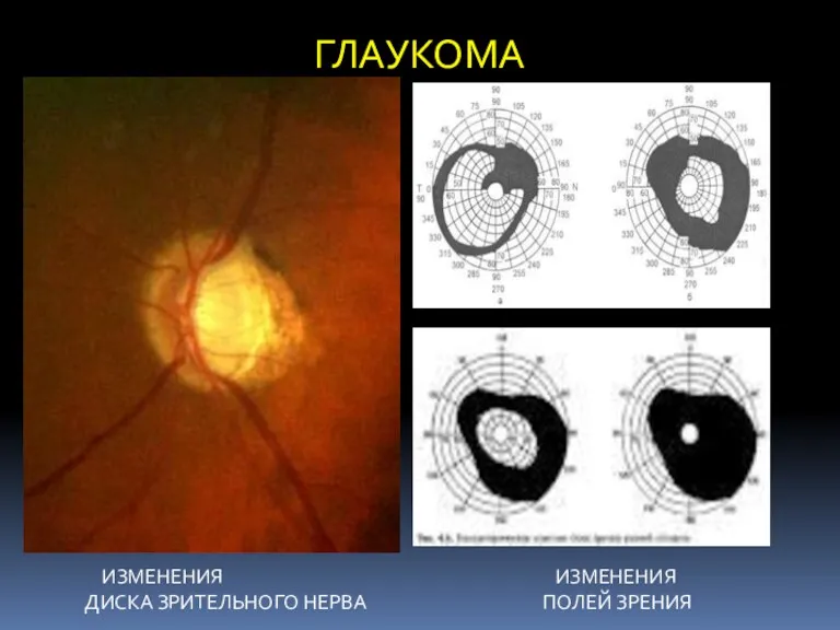 ГЛАУКОМА ИЗМЕНЕНИЯ ИЗМЕНЕНИЯ ДИСКА ЗРИТЕЛЬНОГО НЕРВА ПОЛЕЙ ЗРЕНИЯ