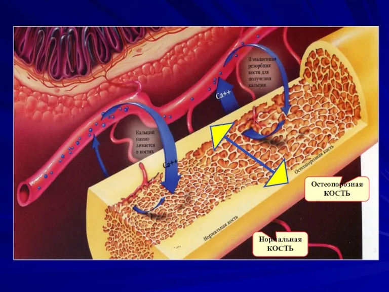 Нормальная КОСТЬ Остеопорозная КОСТЬ