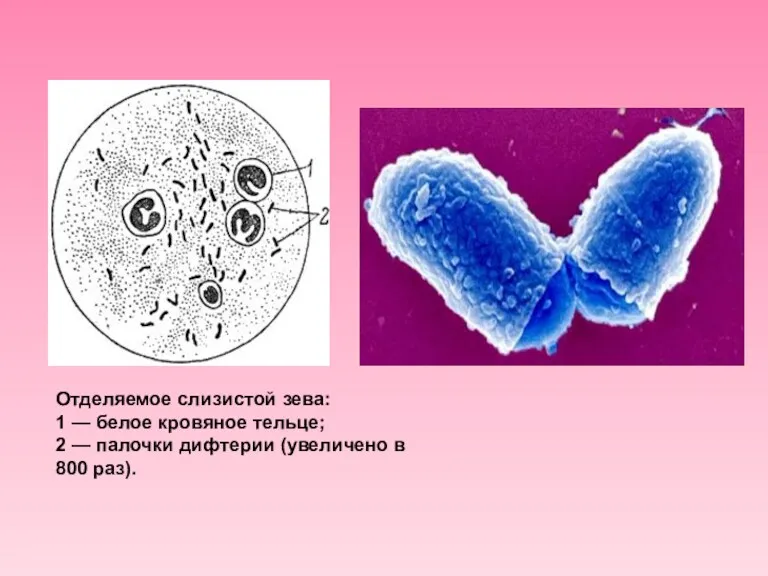 Отделяемое слизистой зева: 1 — белое кровяное тельце; 2 — палочки дифтерии (увеличено в 800 раз).