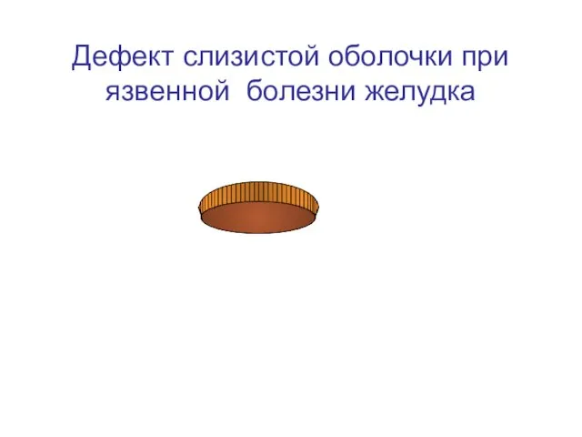 Дефект слизистой оболочки при язвенной болезни желудка