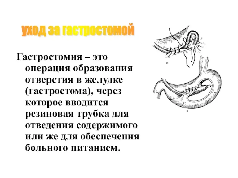 Гастростомия – это операция образования отверстия в желудке (гастростома), через которое вводится резиновая