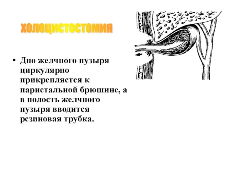 Дно желчного пузыря циркулярно прикрепляется к париетальной брюшине, а в