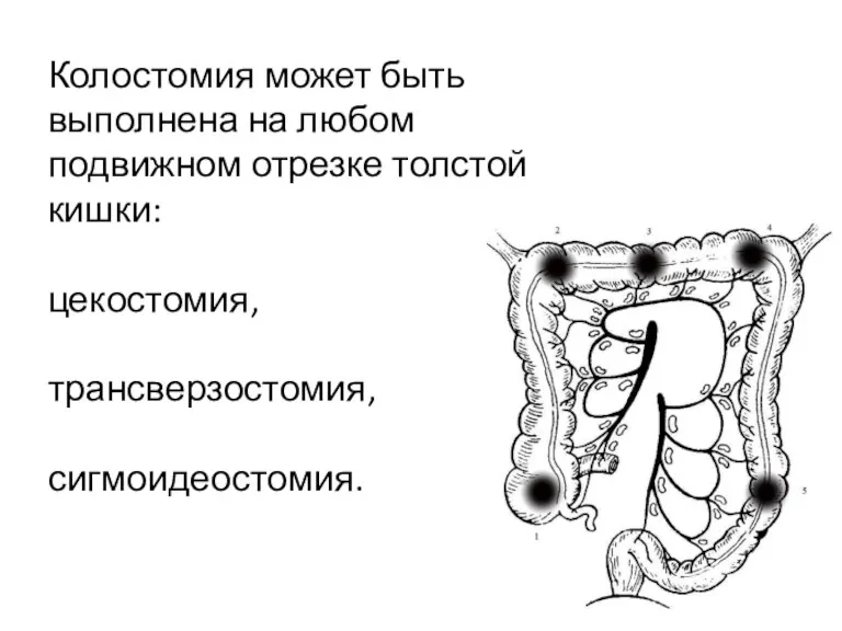 Колостомия может быть выполнена на любом подвижном отрезке толстой кишки: цекостомия, трансверзостомия, сигмоидеостомия.