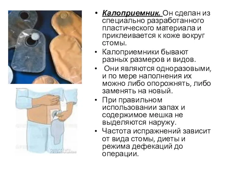 Калоприемник. Он сделан из специально разработанного пластического материала и приклеивается к коже вокруг