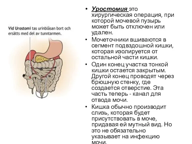 Уростомия это хирургическая операция, при которой мочевой пузырь может быть