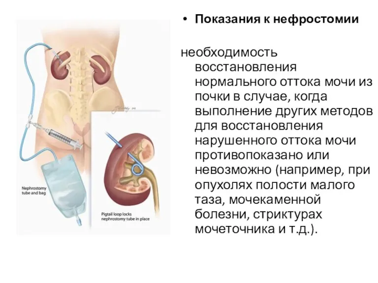 Показания к нефростомии необходимость восстановления нормального оттока мочи из почки