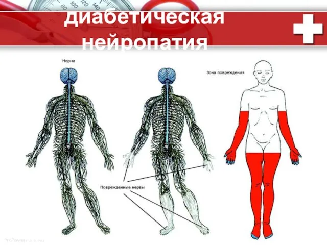 диабетическая нейропатия