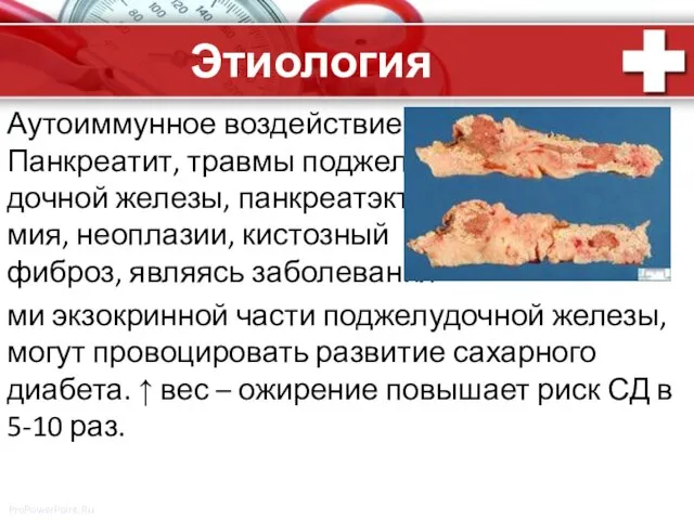 Этиология Аутоиммунное воздействие Панкреатит, травмы поджелу- дочной железы, панкреатэкто- мия,