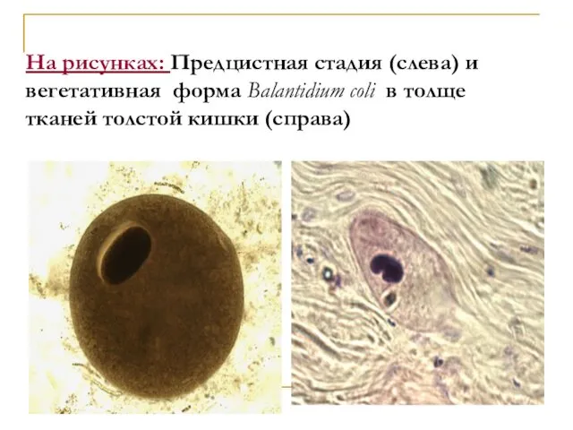 На рисунках: Предцистная стадия (слева) и вегетативная форма Balantidium coli в толще тканей толстой кишки (справа)