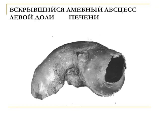 ВСКРЫВШИЙСЯ АМЕБНЫЙ АБСЦЕСС ЛЕВОЙ ДОЛИ ПЕЧЕНИ