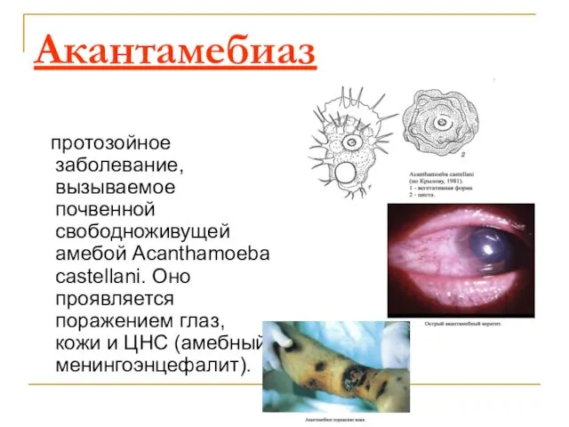 Акантамебиаз протозойное заболевание, вызываемое почвенной свободноживущей амебой Acanthamoeba castellani. Оно