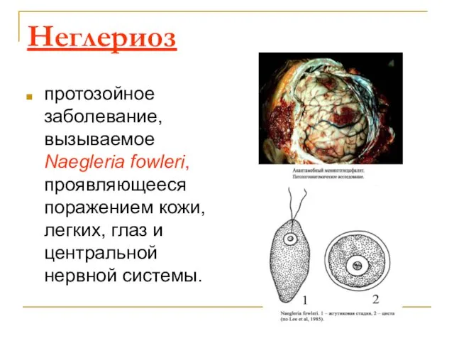 Неглериоз протозойное заболевание, вызываемое Naegleria fowleri, проявляющееся поражением кожи, легких, глаз и центральной нервной системы.