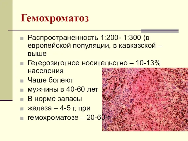Гемохроматоз Распространенность 1:200- 1:300 (в европейской популяции, в кавказской – выше Гетерозиготное носительство