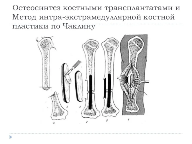 Остеосинтез костными трансплантатами и Метод интра-экстрамедуллярной костной пластики по Чаклину