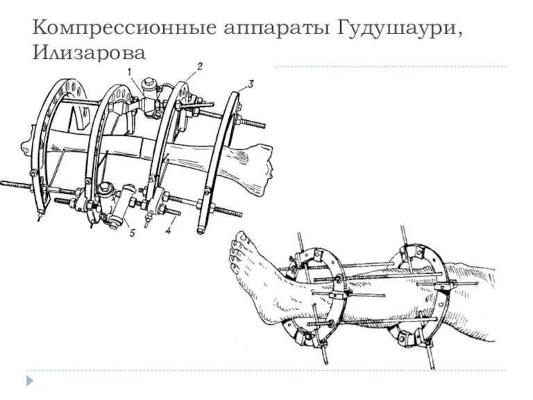 Компрессионные аппараты Гудушаури, Илизарова