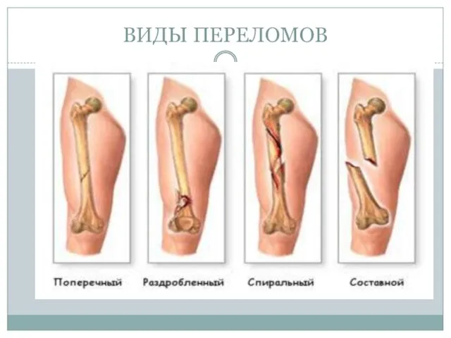 ВИДЫ ПЕРЕЛОМОВ