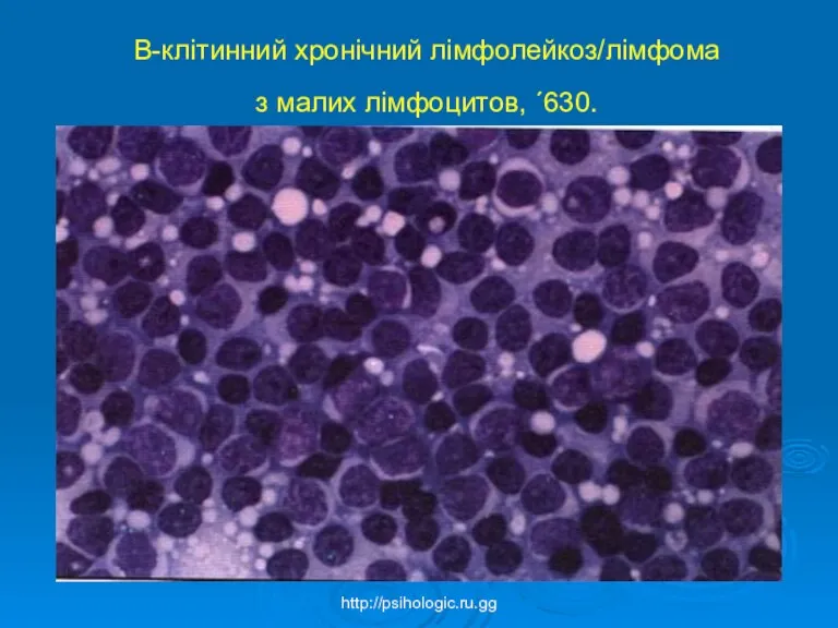 B-клітинний хронічний лімфолейкоз/лімфома з малих лімфоцитов, ´630. http://psihologic.ru.gg