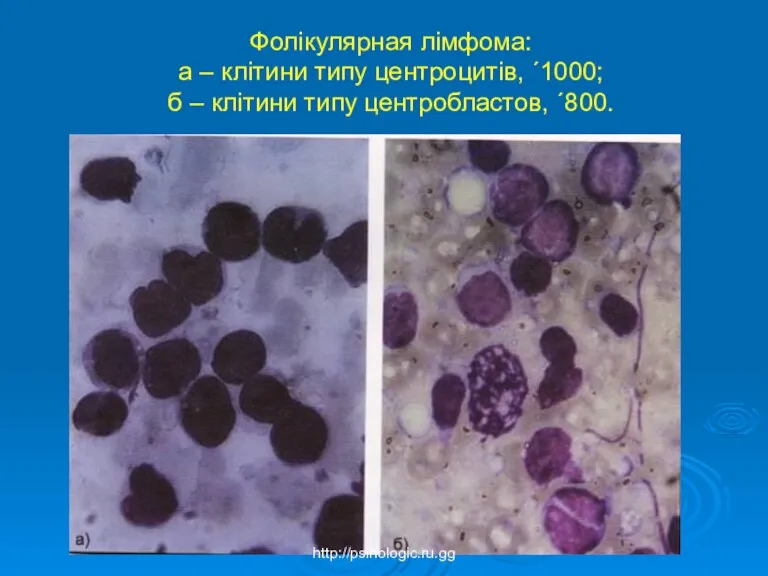 Фолікулярная лімфома: а – клітини типу центроцитів, ´1000; б – клітини типу центробластов, ´800. http://psihologic.ru.gg