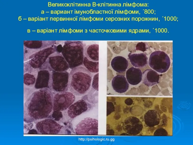 Великоклітинна B-клітинна лімфома: а – вариант імунобластної лімфоми, ´800; б