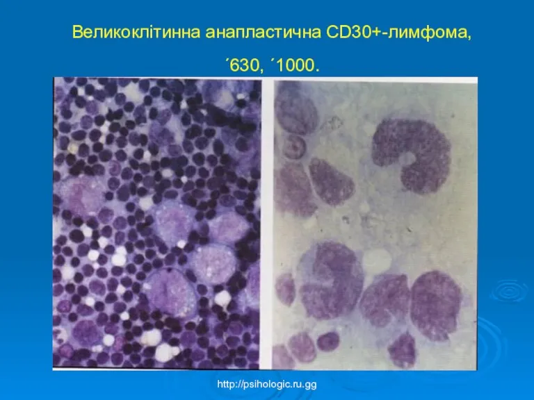 Великоклітинна анапластична CD30+-лимфома, ´630, ´1000. http://psihologic.ru.gg