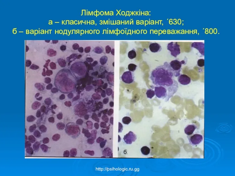 Лімфома Ходжкіна: а – класична, змішаний варіант, ´630; б – варіант нодулярного лімфоїдного переважання, ´800. http://psihologic.ru.gg