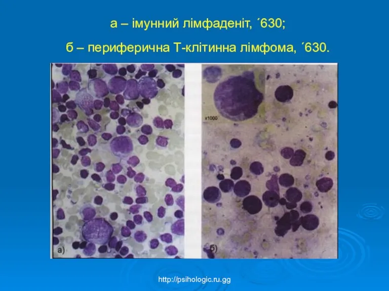 а – імунний лімфаденіт, ´630; б – периферична Т-клітинна лімфома, ´630. http://psihologic.ru.gg